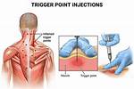 Cpt Trigger Point Injection