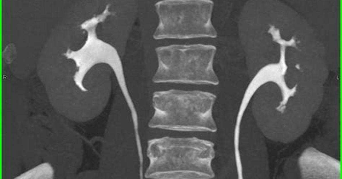 Ct Urogram