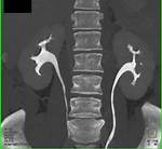 Ct Urogram