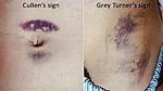 Cullen Sign