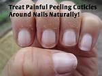 Cuticles Peeling