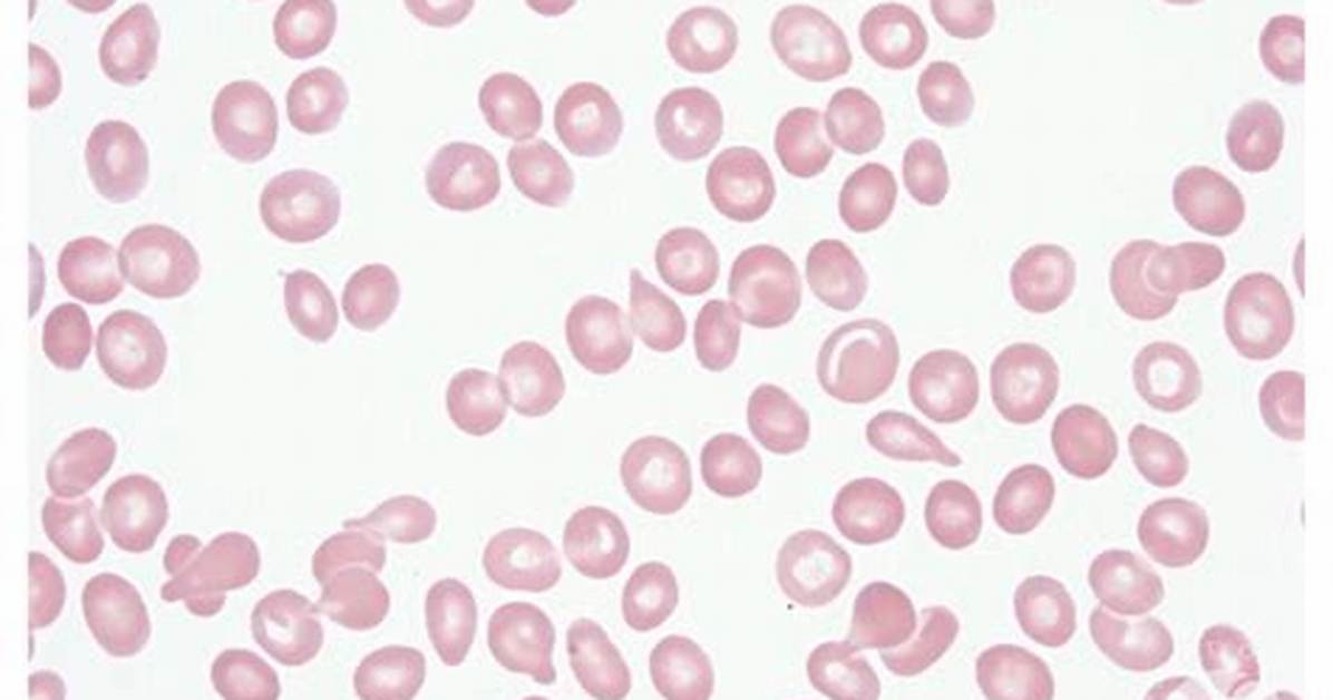Dacrocytes