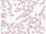 Dacrocytes