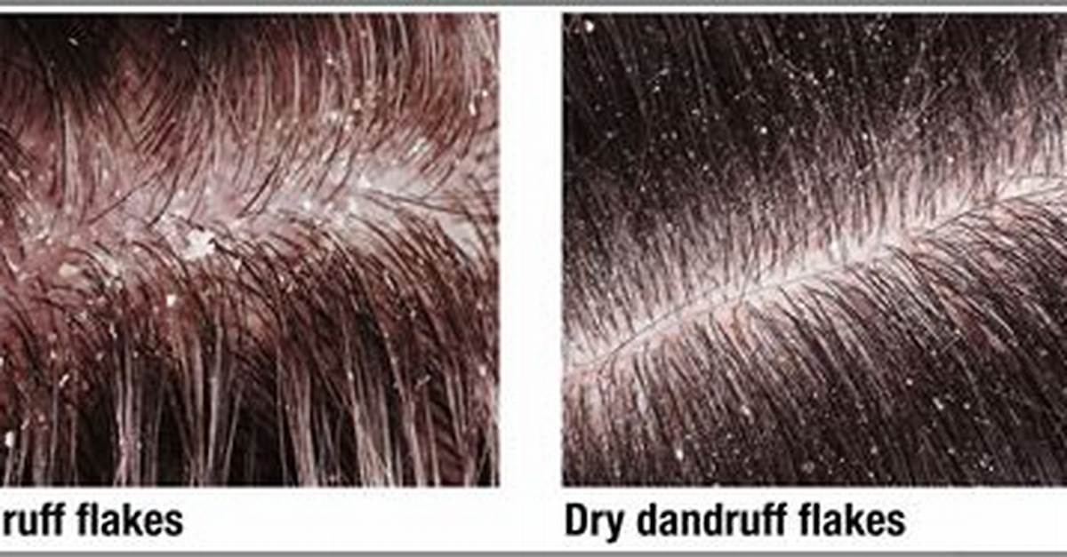 Dandruff Definition