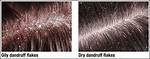 Dandruff Definition