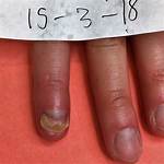 Dead Fingernail