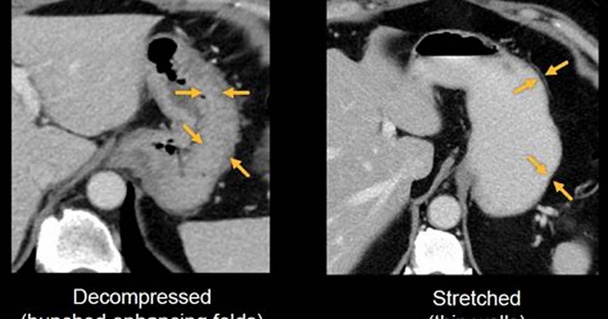 Decompressed Stomach