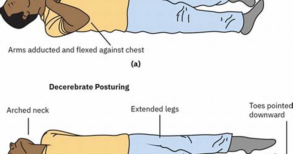 Decorticate Posture