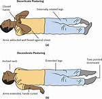 Decorticate Posture