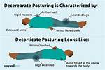 Decorticate vs Decerebrate Posturing