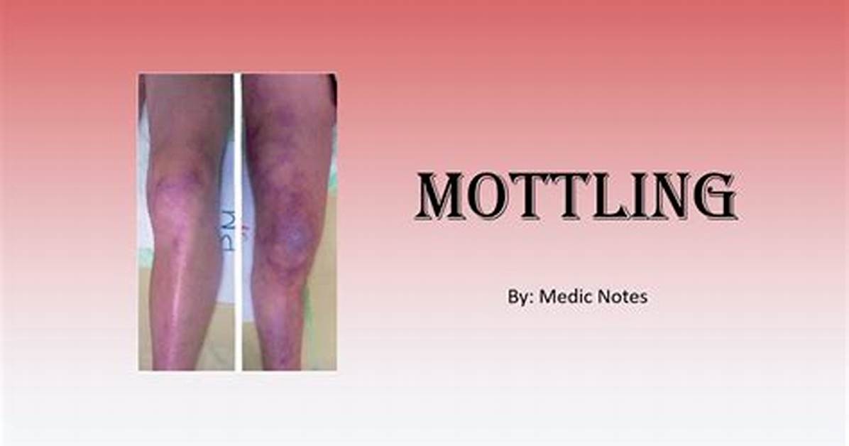 Define Mottled