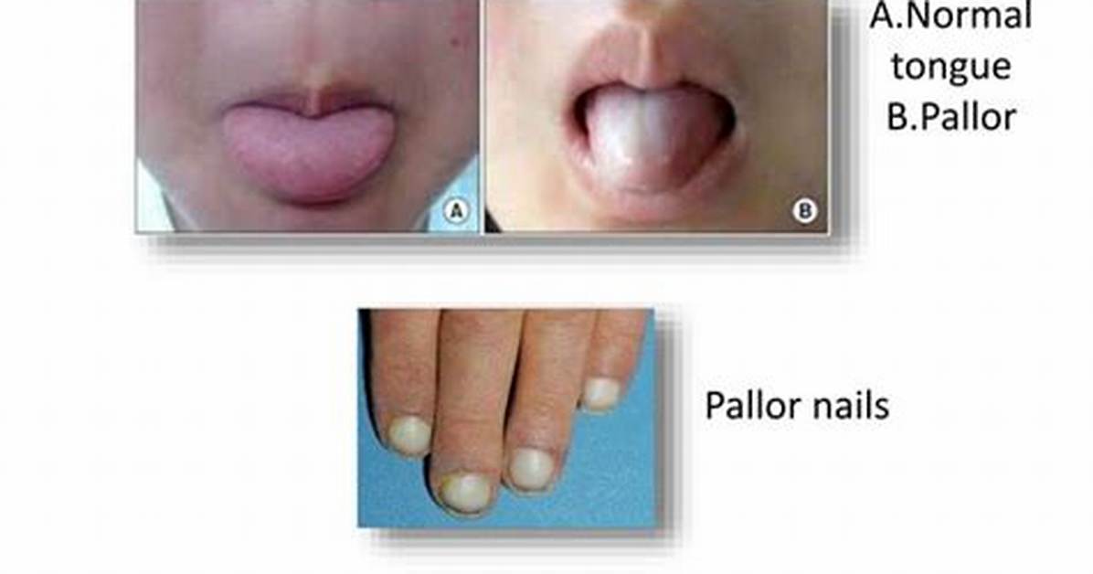 Define Pallor