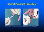 Dermal Puncture