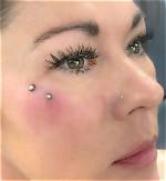 Dermals on Face