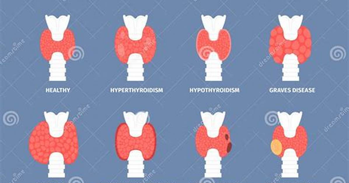 Did Chernobyl Cause Thyroid Problems?
