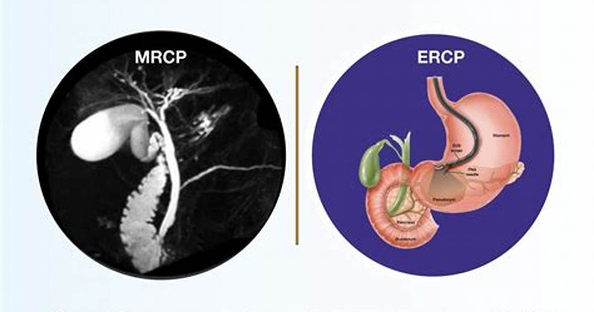 Difference Between Ercp and Mrcp