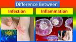 Difference Between Infection and Inflammation