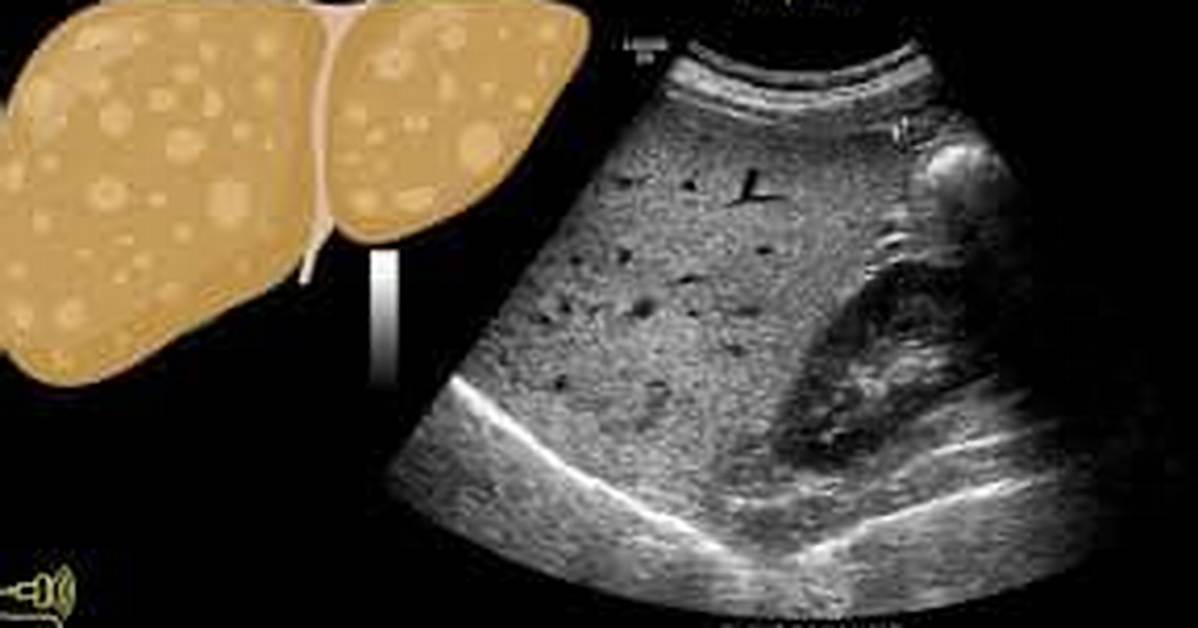 Diffusely Echogenic Liver