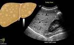 Diffusely Echogenic Liver