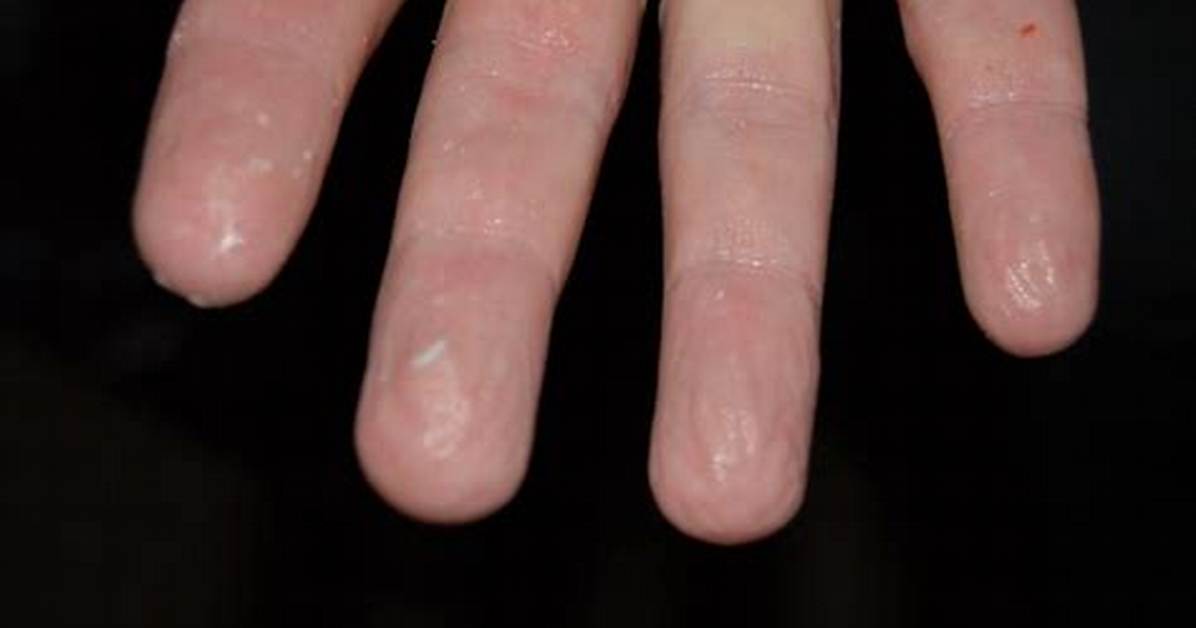 Dishpan Hands