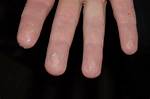 Dishpan Hands