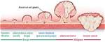 Do Adenomas Grow Back?