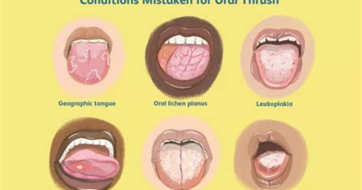 Do Adults Get Thrush?