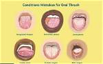 Do Adults Get Thrush?