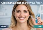 Do Aligners Change Face Shape?