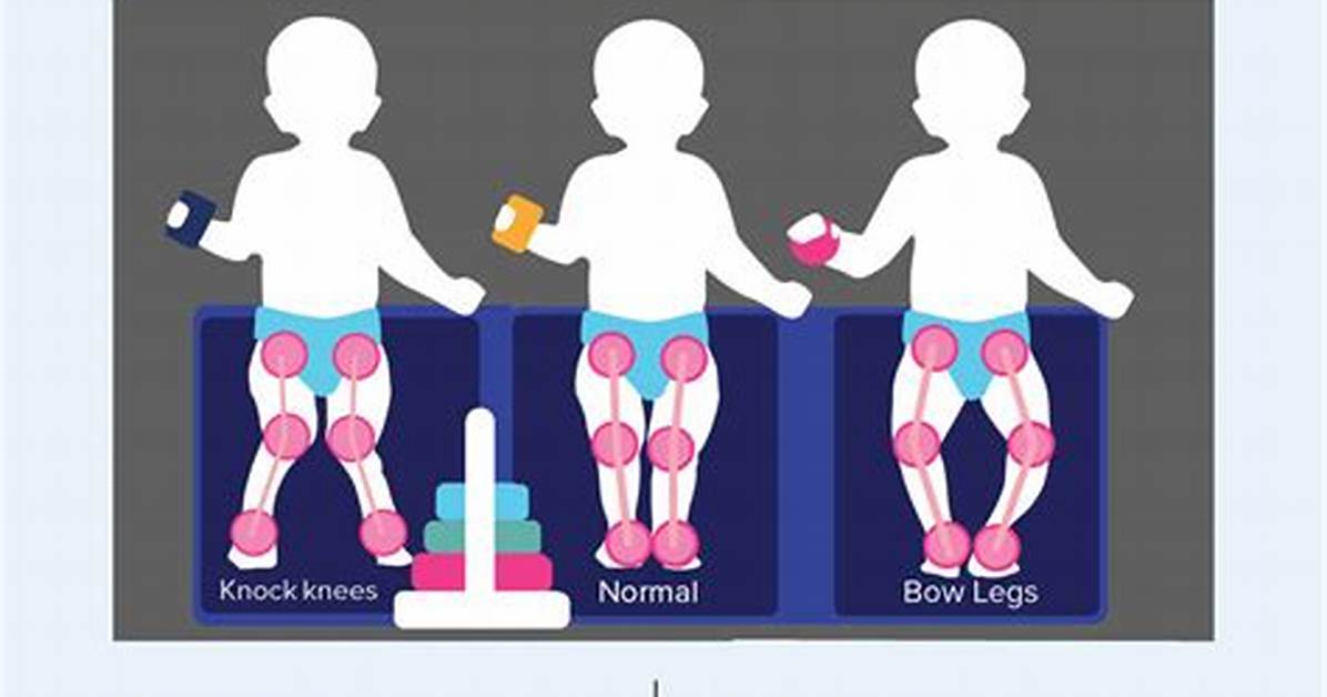 Do Babies Get Bowlegged?