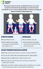 Do Babies Get Bowlegged?