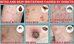 Do Bed Mites Bite