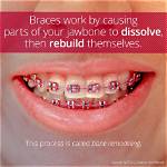 Do Braces Dissolve Jawbone?