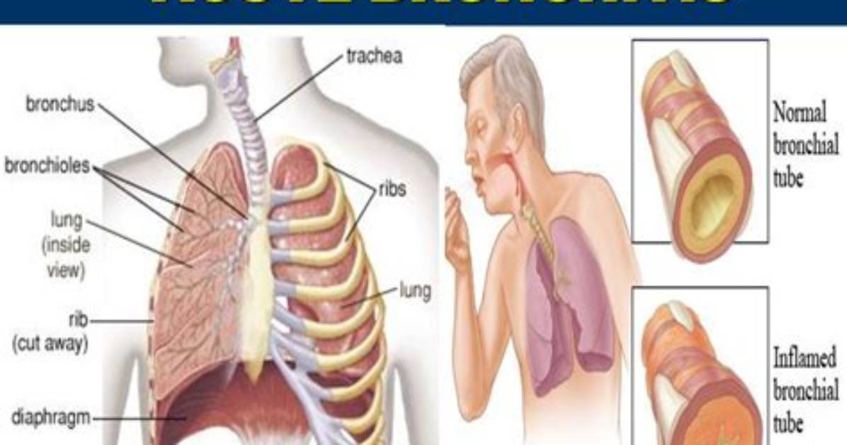 Do Bronchitis Go Away?