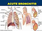 Do Bronchitis Go Away?