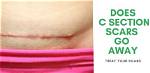Do C Section Scars Go Away?