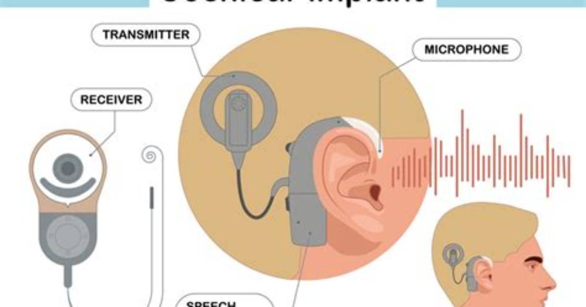 Do Cochlear Implants Make You Hear?