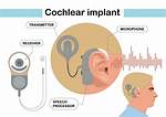 Do Cochlear Implants Make You Hear?