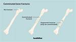 Do Comminuted Fractures Require Surgery?