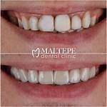 Do Composite Veneers Stain?