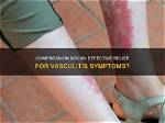 Do Compression Socks Help Vasculitis?