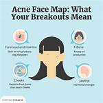 Do Concealer Cause Breakouts?