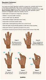 Do Contractures Go Away?