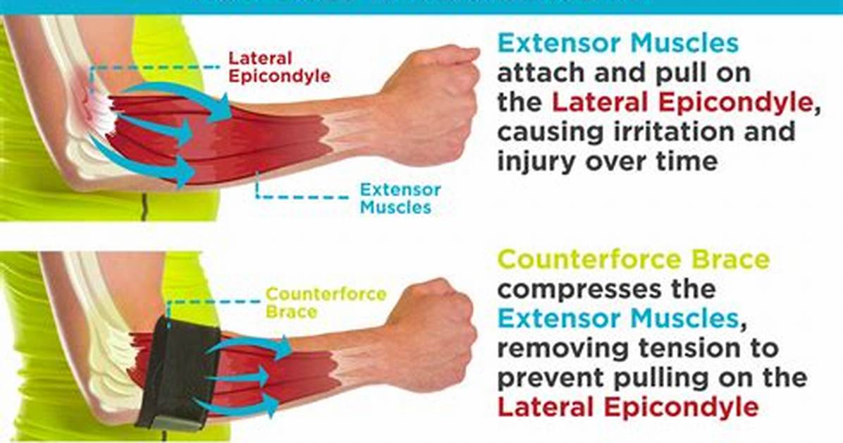 Do Counterforce Braces Work?