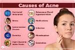 Do Curd Cause Acne?