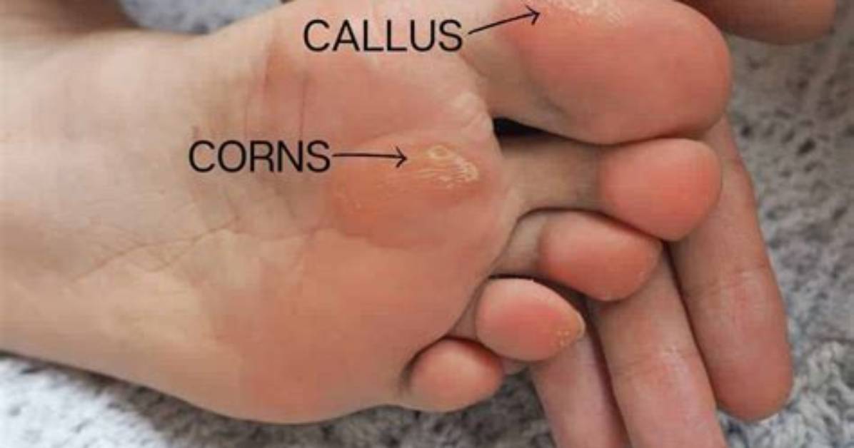 Do Cyclists Have Calluses?