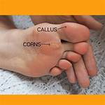 Do Cyclists Have Calluses?