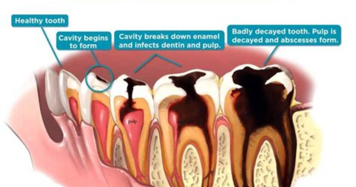 Do Decaying Teeth Hurt?