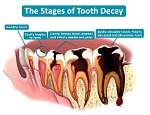 Do Decaying Teeth Hurt?