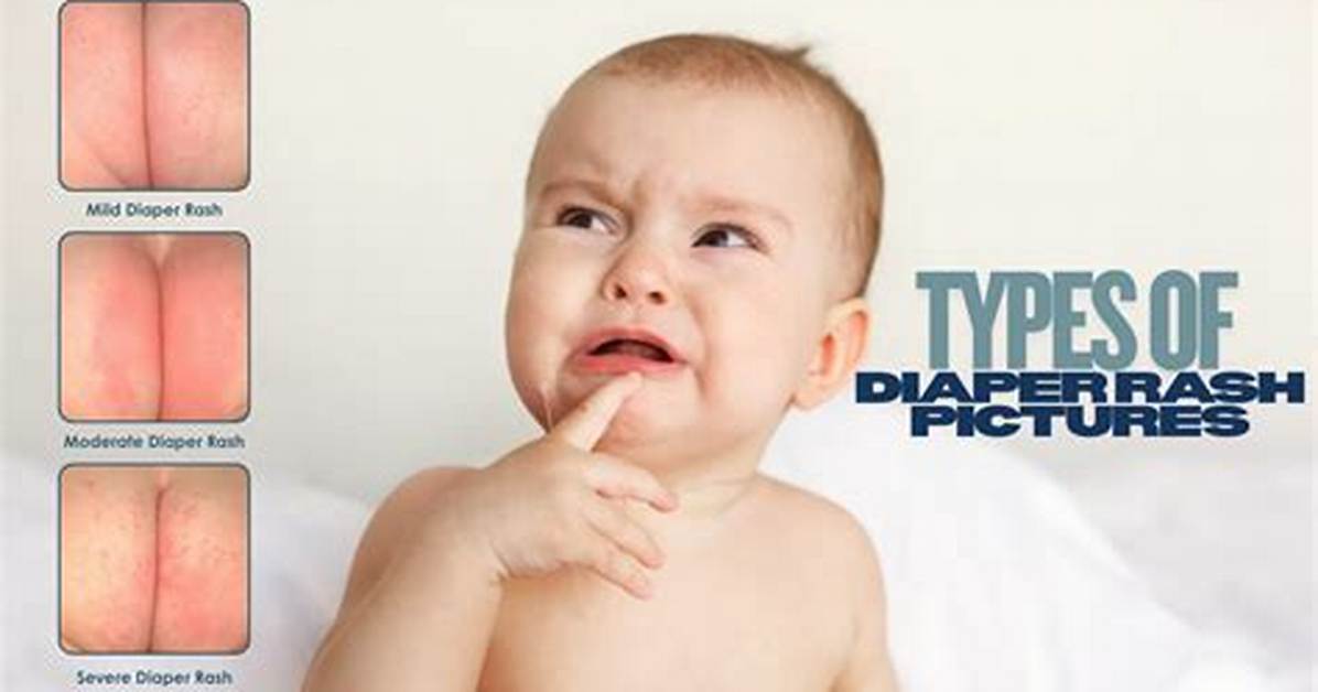 Do Diapers Cause Rashes?
